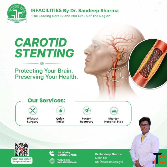 Carotid Angioplasty with Stent to Decrease the Risk of Stroke Effectively