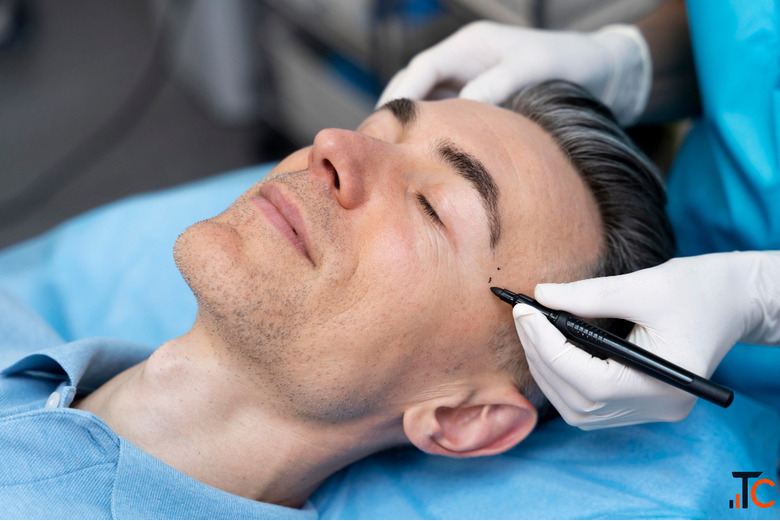Beard Transplant in Kochi Restore a Fuller Beard with Natural-Looking Results