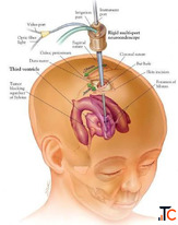 How Endoscopic Skull Surgery is the Best Method for Reaching Brain Tumor Through the Nose