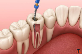 DENTAL IMPLANTS IN MADURAI