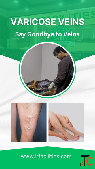 Best Hospital for Varicose Vein Treatment in India State-of-the-Art Treatment