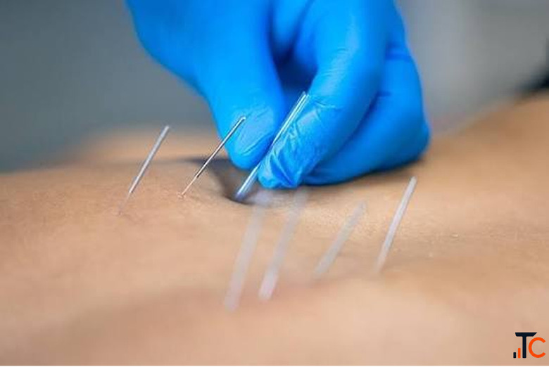 Dry Needling Services in Gurgaon - Expert Pain Relief Muscle Recovery