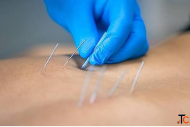 Dry Needling Services in Gurgaon - Expert Pain Relief Muscle Recovery
