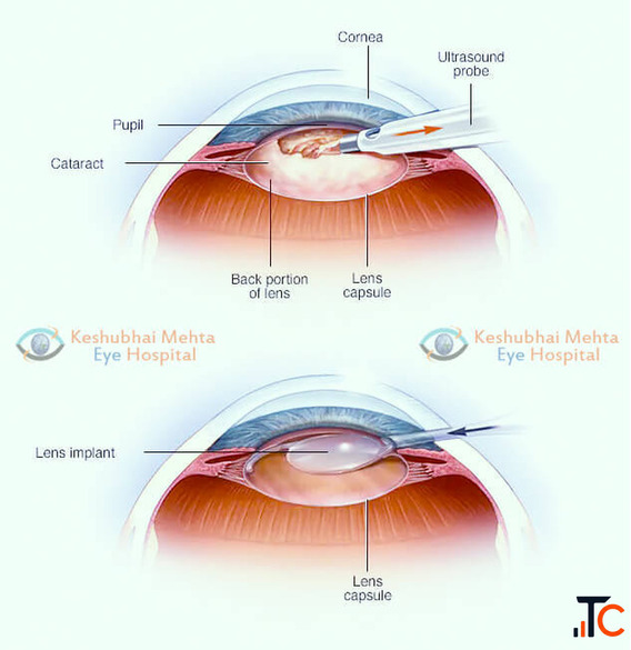 Cataract Operation Rajkot for Clearer Vision and Better Eye Health