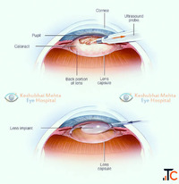 Cataract Operation Rajkot for Clearer Vision and Better Eye Health