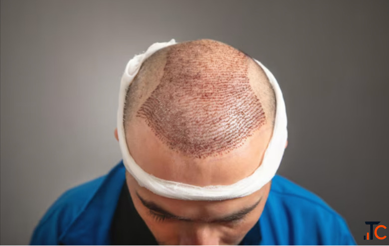 Top Dermatologists for Scalp Micropigmentation