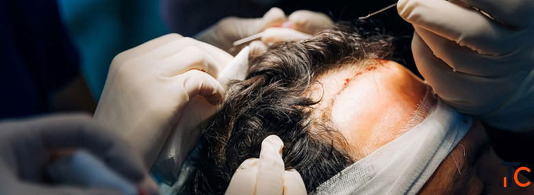 Precision Without the Premium Markup FUE Hair Transplant Price That Surprises