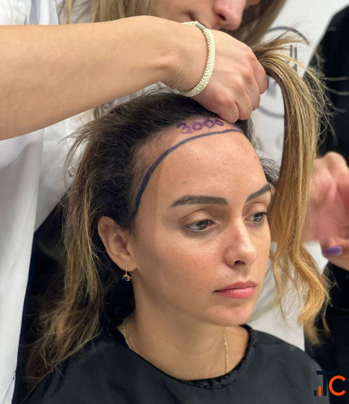 Invest in Yourself Transparent Hair Restoration Cost Zero Surprises