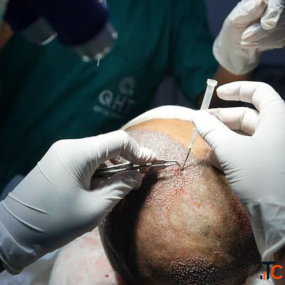 Stop Searching The Best Hair Transplant Surgeon Is Closer Than You Think
