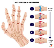 Rheumatoid Arthritis Treatment in Gurgaon Expert Physiotherapy for Joint Pain Relief