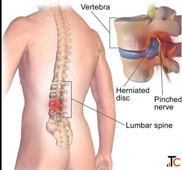 Spinal Rehabilitation in Gurgaon Expert Spine Pain Recovery Physiotherapy