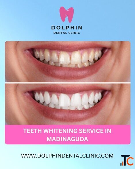 Professional Teeth Whitening Service in Madinaguda - Brighten Your Smile Naturally