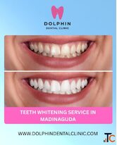 Professional Teeth Whitening Service in Madinaguda - Brighten Your Smile Naturally