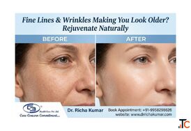 Fine Lines Wrinkles Making You Look Older Rejuvenate Naturally