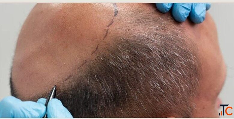 Hair Transplant Near DLF Phase Area Gurgaon