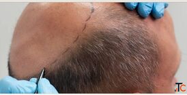 Hair Transplant Near DLF Phase Area Gurgaon