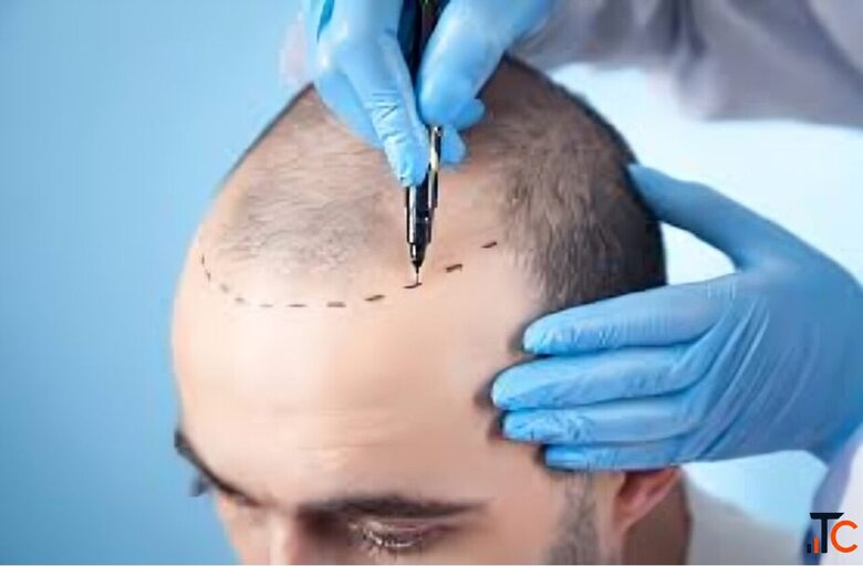 Affordable Hair Transplant in Delhi Premium Results Budget-Friendly Plans