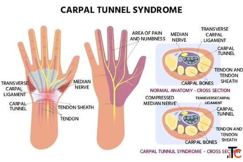 Carpal Tunnel Syndrome Treatments in Gurgaon Expert Physiotherapy for Wrist Hand Pain