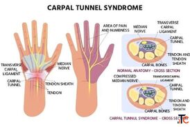 Carpal Tunnel Syndrome Treatments in Gurgaon Expert Physiotherapy for Wrist Hand Pain