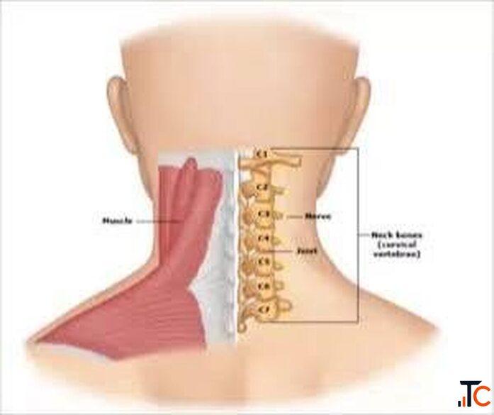 Cervical Spondylosis Treatment in Gurgaon Expert Neck Pain Spine Physiotherapy