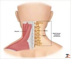 Cervical Spondylosis Treatment in Gurgaon Expert Neck Pain Spine Physiotherapy