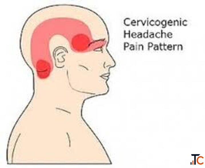 Cervicogenic Headaches Treatment in Gurgaon Expert Physiotherapy for Neck-Related Headaches