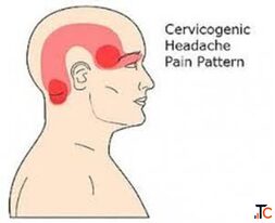 Cervicogenic Headaches Treatment in Gurgaon Expert Physiotherapy for Neck-Related Headaches