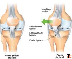 Chondromalacia Patella Treatment in Gurgaon Expert Knee Pain Physiotherapy Rehabilitation