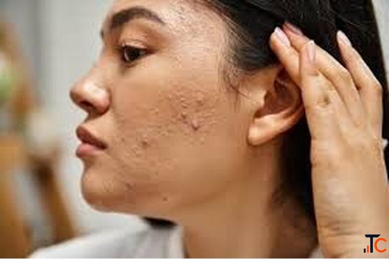 Acne Scar Removal Treatment in GK2 Delhi for Clearer Smoother Skin