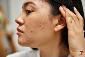 Acne Scar Removal Treatment in GK2 Delhi for Clearer Smoother Skin