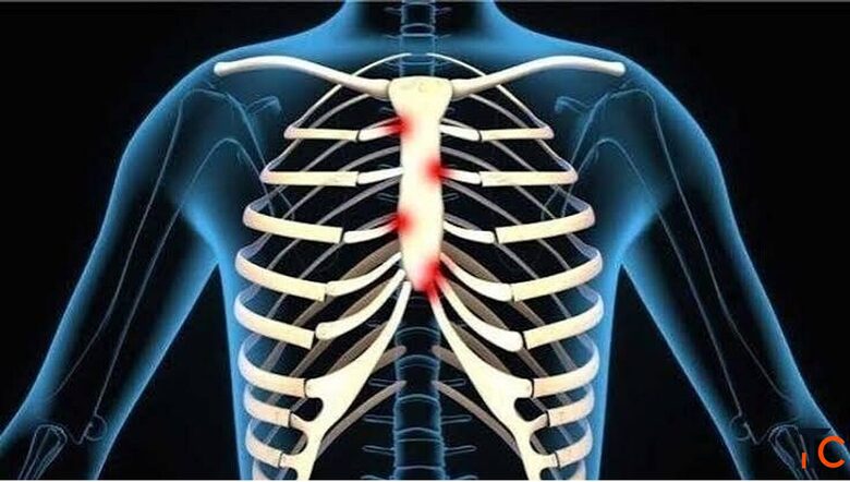 Costochondritis Physiotherapy Treatment in Gurgaon Expert Physiotherapy for Chest Wall Pain Relief