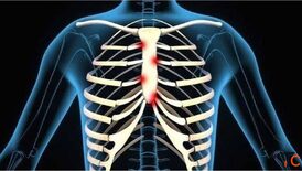 Costochondritis Physiotherapy Treatment in Gurgaon Expert Physiotherapy for Chest Wall Pain Relief