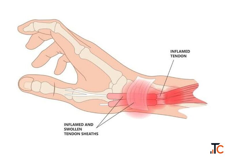 De Quervain Tenosynovitis Treatment in Gurgaon Expert Physiotherapy for Wrist Thumb Pain