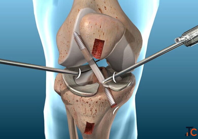 Best Doctor for ACL Reconstruction in Panchkula