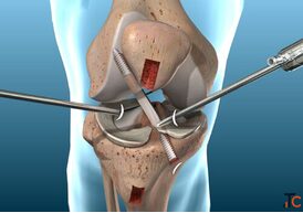 Best Doctor for ACL Reconstruction in Panchkula