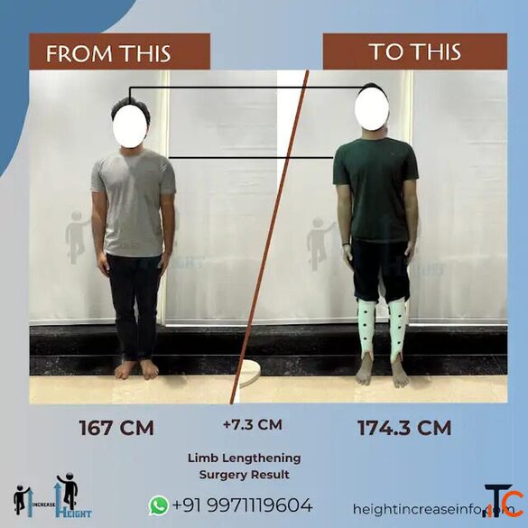 Height Increase Surgery in Gurgaon India