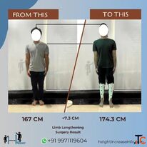 Height Increase Surgery in Gurgaon India