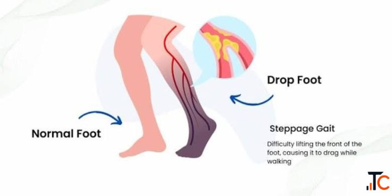 Foot Drop Treatment in Gurgaon Expert Physiotherapy for Faster Recovery