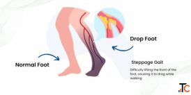Foot Drop Treatment in Gurgaon Expert Physiotherapy for Faster Recovery