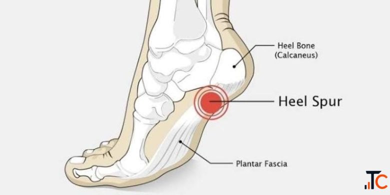 Calcaneal Spur Treatment in Gurgaon Expert Heel Pain Physiotherapy
