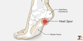 Calcaneal Spur Treatment in Gurgaon Expert Heel Pain Physiotherapy