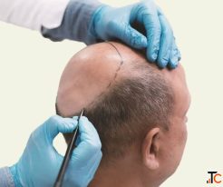 Get Smooth Scalp Fuller Hair with The Botox Hair Treatment