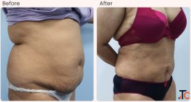 Liposuction Surgery in Delhi - Dr Rajat Gupta