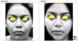 Buccal Pad Fat Removal Surgery in Delhi - Dr Rajat Gupta