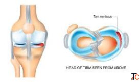 Meniscus Injury in Gurgaon Repairing Mobility using the highest level of precision