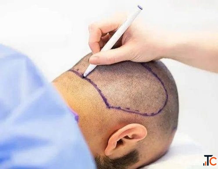 India's Premier Hair Transplant Clinic Trusted by Thousands