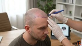 The Secret Behind Every Star's Perfect Hairline Revealed