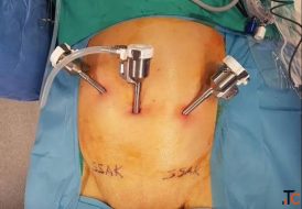 Hiatal Hernia Surgery in Delhi - Advanced Treatment