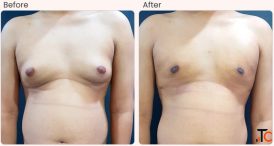 Gynecomastia Surgery Cost in Delhi - Dr Rajat Gupta