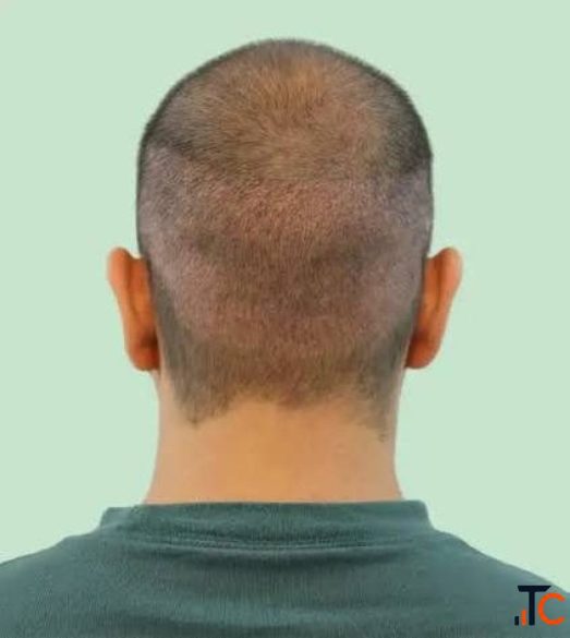 Stop Hair Loss Before It Stops You with Expert Treatment in Delhi